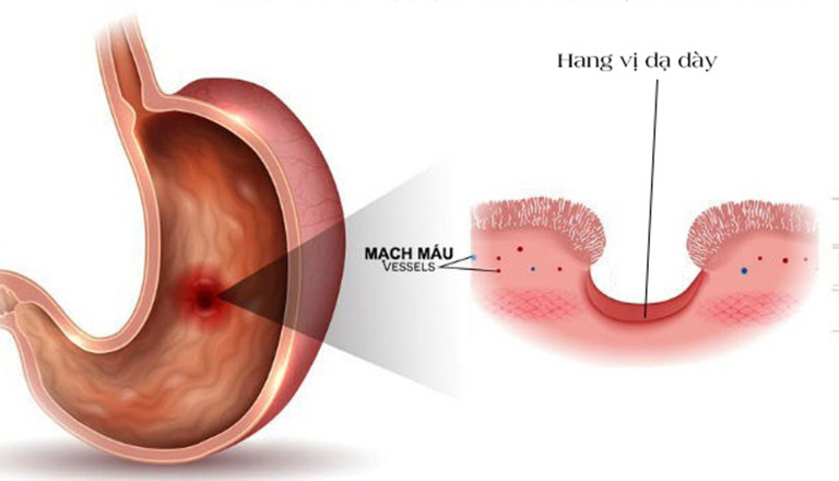 viêm hang vị dạ dày là gì