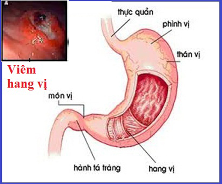 Viêm hang vị có các triệu chứng giống với các bệnh dạ dày khác, người bệnh cần chú ý để điều trị đúng