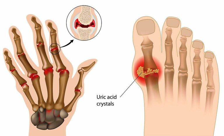 Cách phân biệt viêm khớp dạng thấp và gout