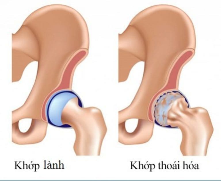 phân biệt viêm khớp dạng thấp và thoái hóa khớp