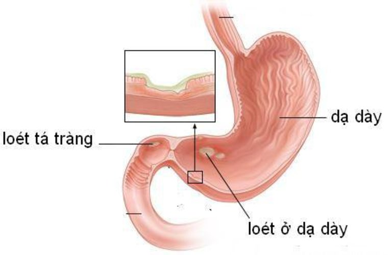 Viêm loét tá tràng thường đi kèm với viêm loét dạ dày nên người ta hay gọi chung là bệnh viêm loét dạ dày - tá tràng