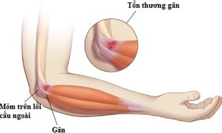 Viêm lồi cầu ngoài xương cánh tay là căn bệnh lành tính, có thể kéo dài trong vài ngày, vài tháng, đôi khi là cả năm