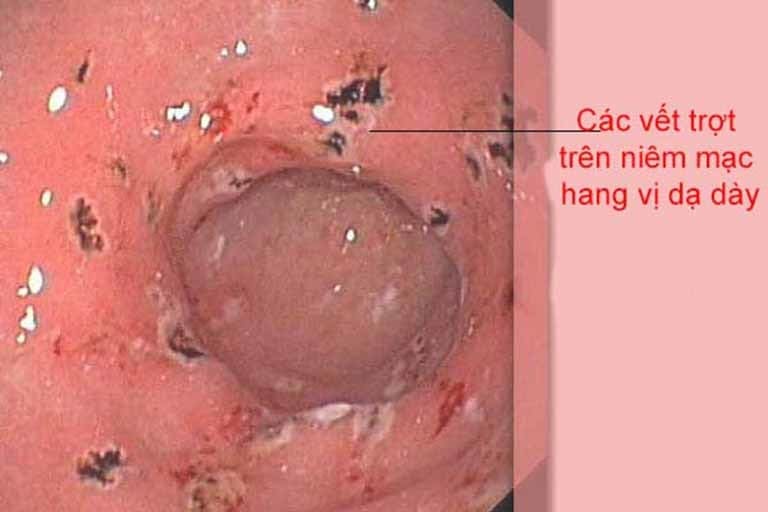 Viêm phù nề xung huyết trợt rải rác hang vị là bệnh gì?