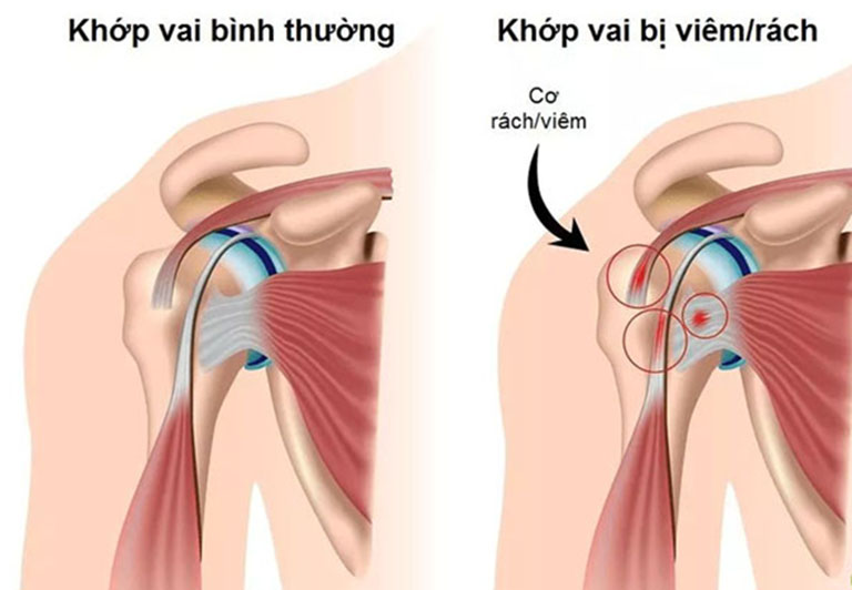 Khớp vai bị viêm rách dễ dẫn đến viêm quanh khớp vai