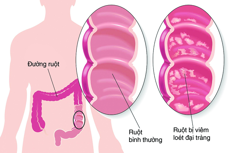 triệu chứng viêm ruột thừa cấp