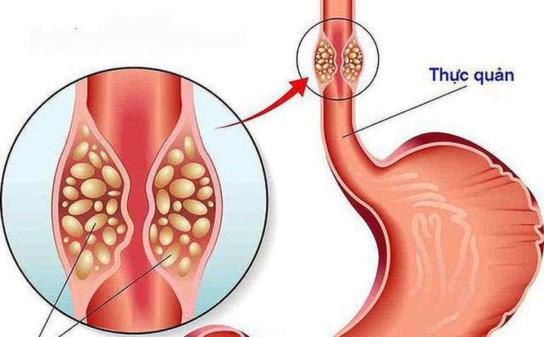 điều trị viêm thực quản