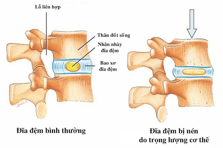 Xẹp đĩa đệm