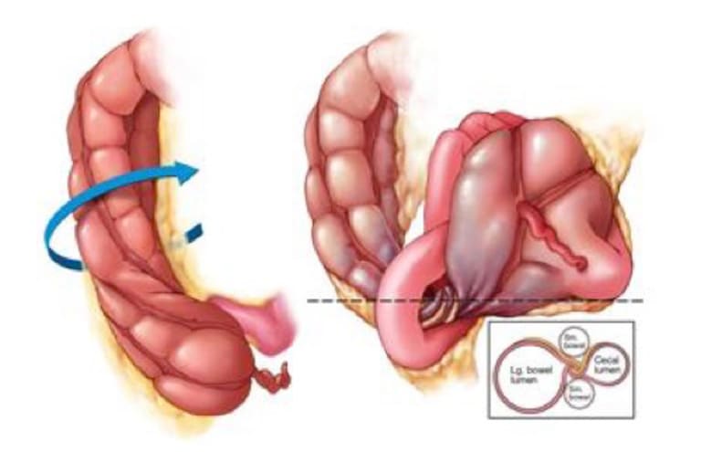 Xoắn đại tràng là một trong những nguyên nhân gây tắc ruột và đe dọa trực tiếp đến tính mạng